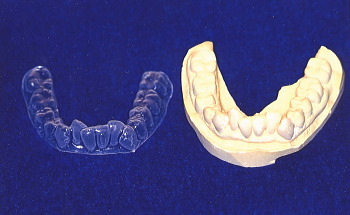 歯周病について説明